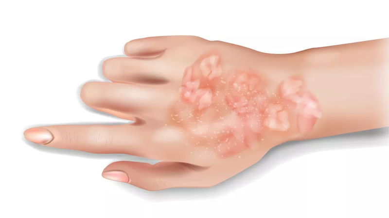 Psoriasis: Gejala dan Tips Pencegahan dari PAFI Kuningan